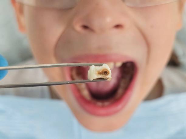 Best Emergency Broken Tooth Repair in Rockville, MD